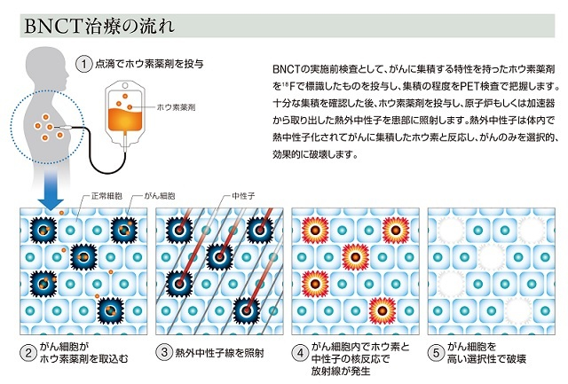 BNCT治療の流れ