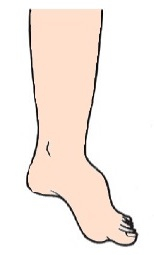 Equinus