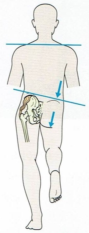 TrenderenburgGait