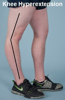 hyperextended-knee